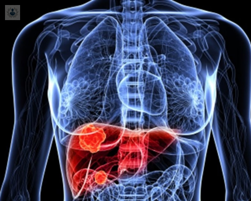 Tumores de Hígado: ¿cuál es la diferencia entre Benignos y Malignos?