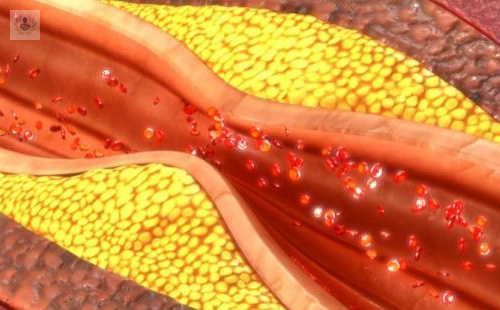 ¿Cómo prevenir la Arterioesclerosis? Descubre las mejores formas de evitarla