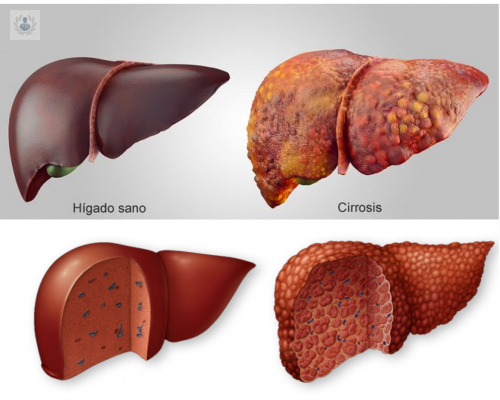 Cirrosis desde su causa hasta su tratamiento