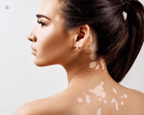 que-es-el-vitiligo-descubre-todo-al-respecto imagen de artículo