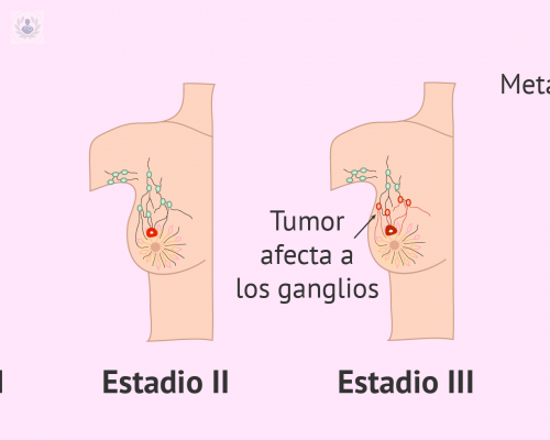 factores-de-riesgo-del-cancer-de-mama imagen de artículo
