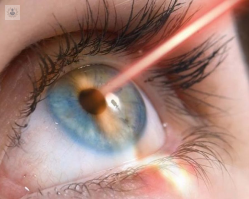 beneficios-del-tratamiento-laser-para-corregir-la-miopia imagen de artículo