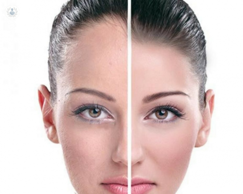 frontoplastia-un-procedimiento-para-disminuir-el-tamano-de-la-frente imagen de artículo