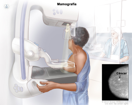 Mamografía: ¿por qué es importante realizarse el examen?