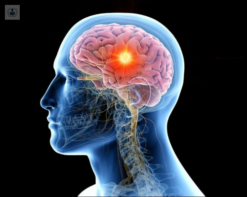 ¿Cuáles son los síntomas de un Tumor Cerebral?