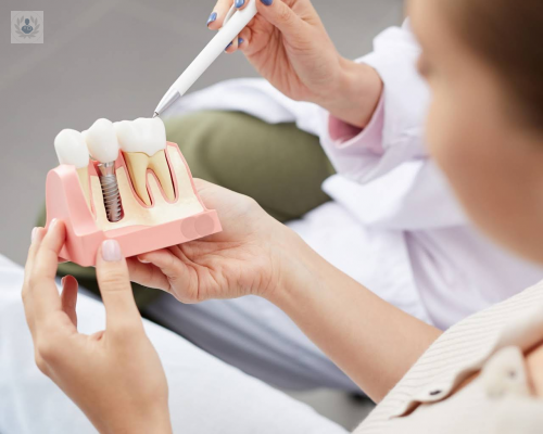 implantes-dentales-mitos-y-realidades imagen de artículo
