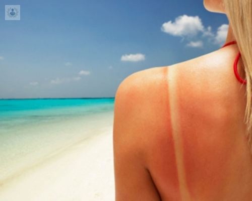relacion-entre-la-exposicion-solar-y-el-cancer-de-piel imagen de artículo