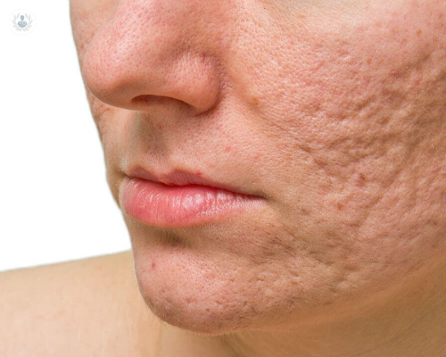 como-evitar-las-cicatrices-por-acne imagen de artículo