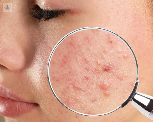 como-evitar-las-cicatrices-del-acne imagen de artículo