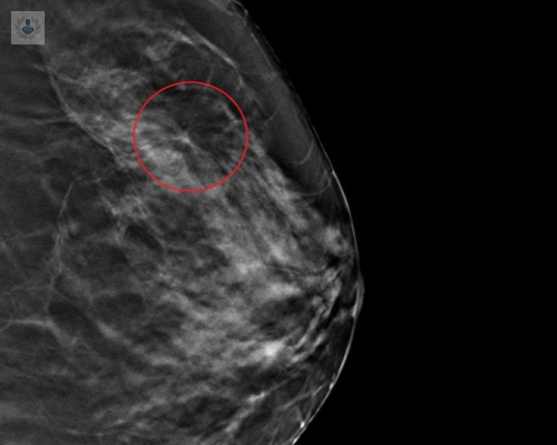 cancer-de-mama-sintomas-y-senales imagen de artículo