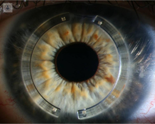 anillos-de-queratocono-una-nueva-forma-de-detener-la-perdida-de-la-vision imagen de artículo