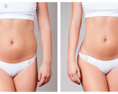 abdominoplastia-riesgos-y-ventajas imagen de artículo