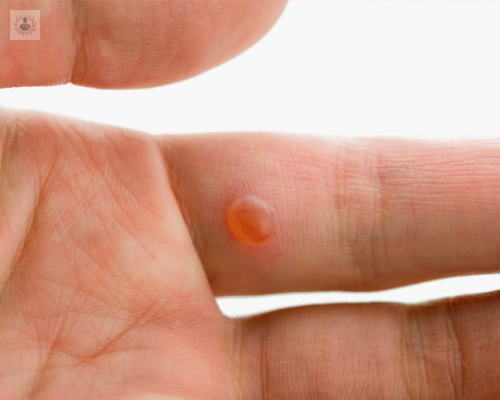 mezquinos-una-infeccion-originada-por-el-virus-del-papiloma-humano-vph imagen de artículo