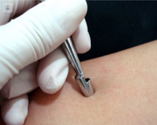 biopsia-de-piel-un-procedimiento-para-diagnosticar-enfermedades-cutaneas imagen de artículo