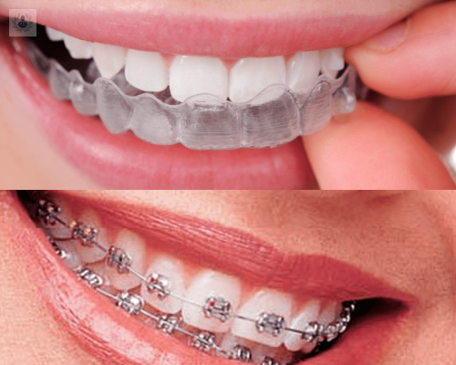 ortodoncia-sin-brackets imagen de artículo
