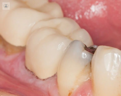 caries-dental imagen de artículo