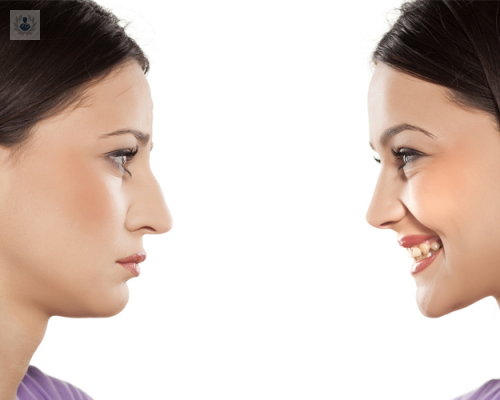 tabique-desviado-tratamiento imagen de artículo