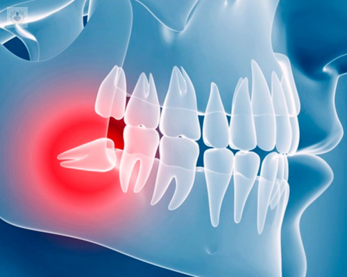extraccion-de-cordales-todo-lo-que-tienes-que-saber-sobre-este-procedimiento imagen de artículo