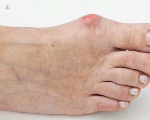 Juanetes, enfermedad común en los pies