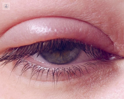 blefaritis-aprenda-a-identificar-esta-patologia imagen de artículo