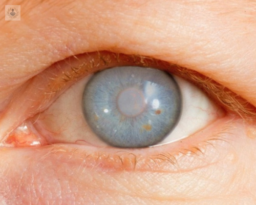Glaucoma y el daño al nervio óptico