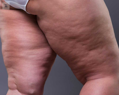 lipedema imagen de artículo