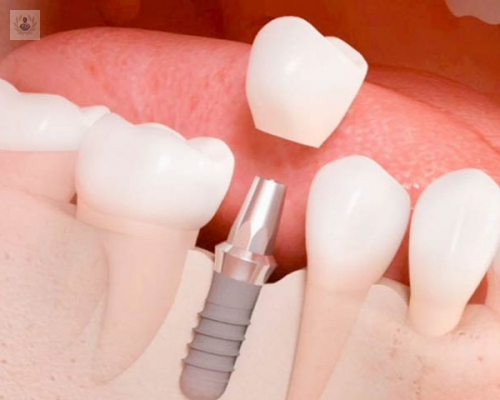 Implantes Dentales: una alternativa con mayor comodidad