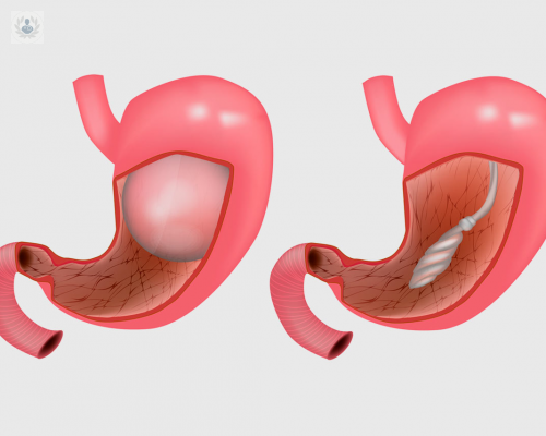 conoce-mas-sobre-el-balon-gastrico imagen de artículo