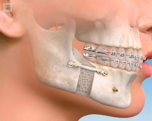Cirugía Maxilofacial: una solución para problemas en los maxilares, dientes y la cavidad oral