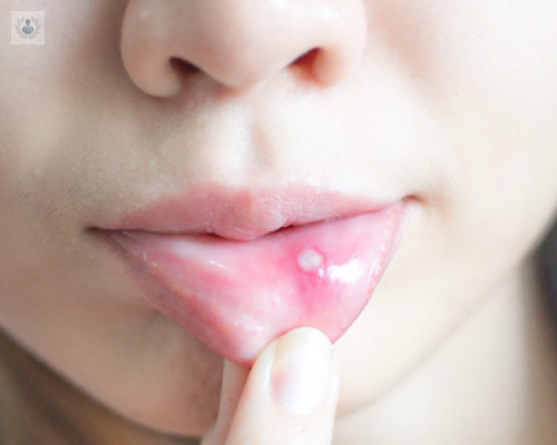 el-fuego-labial-puede-convertirse-en-cancer-de-labio imagen de artículo