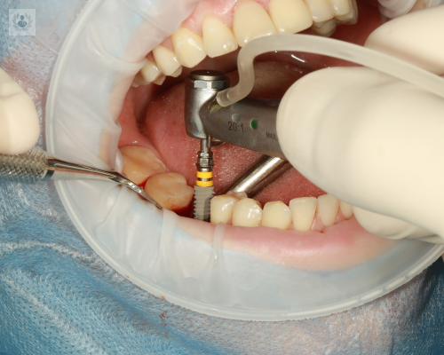 Implantes Dentales, conoce más sobre ellos