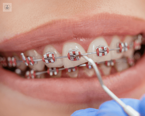 necesito-brackets imagen de artículo