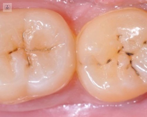 caries-todo-lo-que-tienes-que-saber imagen de artículo