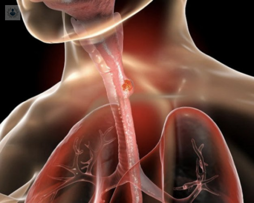 como-identificar-las-varices-esofagicas imagen de artículo