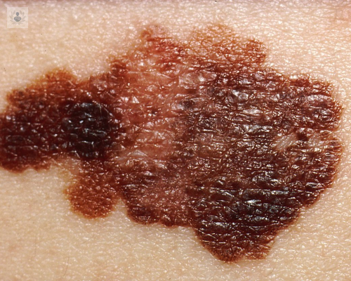 el-abc-del-melanoma imagen de artículo