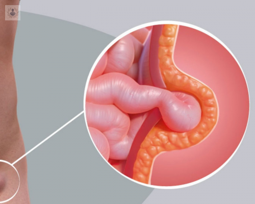 sabes-que-es-la-hernia-inguinal imagen de artículo