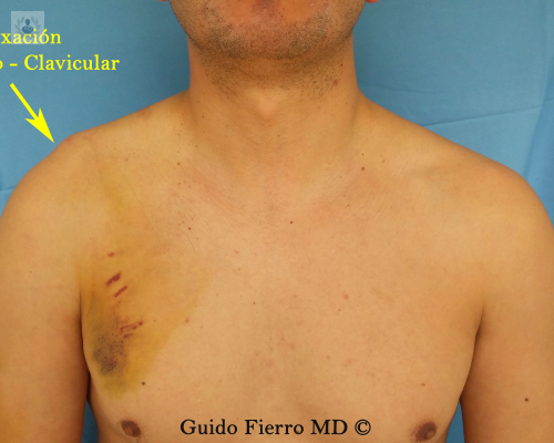 que-sucede-con-la-luxacion-acromion-clavicular imagen de artículo