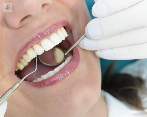 ¿Sabes qué es la Periodontitis?