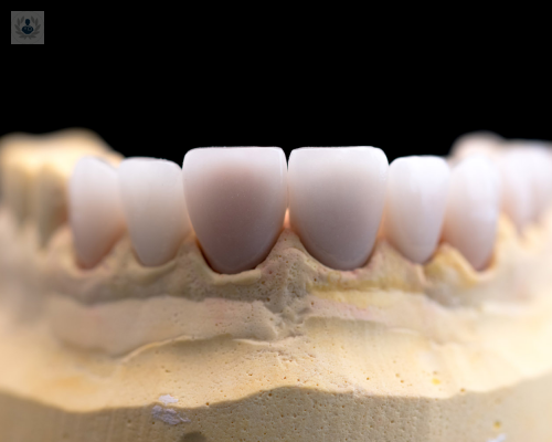 o-coronas-tratamiento-recurrente-de-la-odontologia imagen de artículo