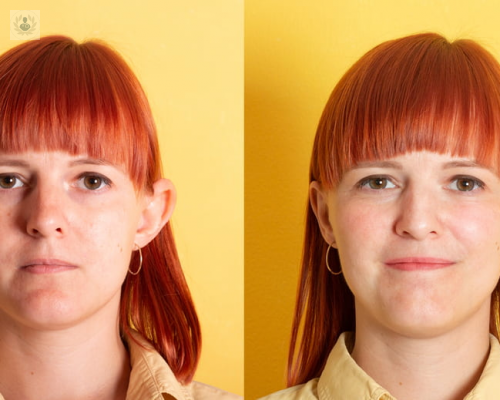 Otoplastia: un procedimiento para mejorar el aspecto de las orejas