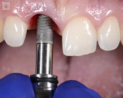 Implantes Dentales, para qué se utilizan