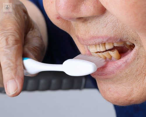 desgaste-dental-y-sus-consecuencias imagen de artículo