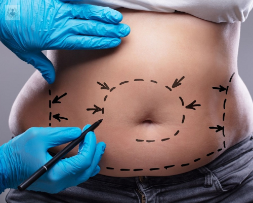 mitos-y-realidades-de-la-liposuccion imagen de artículo