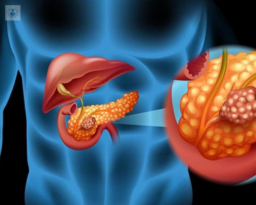 todo-sobre-cancer-de-pancreas imagen de artículo