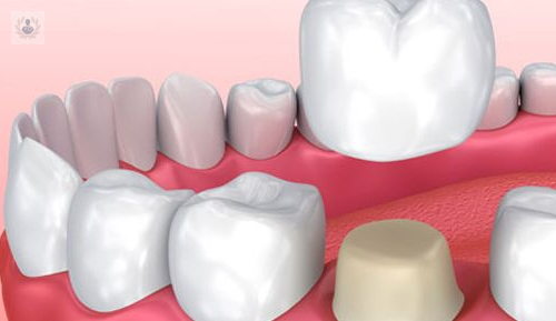 Reconstrucción Dental, ¿qué es?