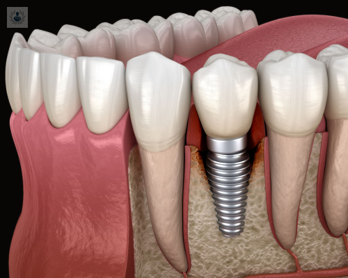 patologias-periimplantares-como-prevenirlas imagen de artículo