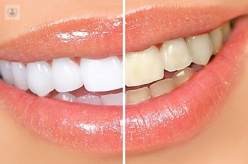 blanqueamiento-dental-vital-y-no-vital imagen de artículo