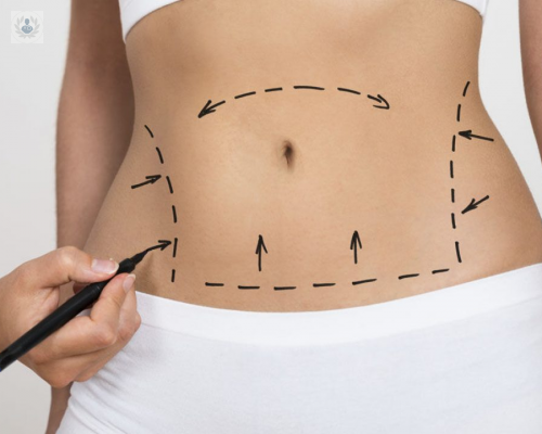 abdominoplastia-plus-un-procedimiento-para-recuperar-la-silueta imagen de artículo