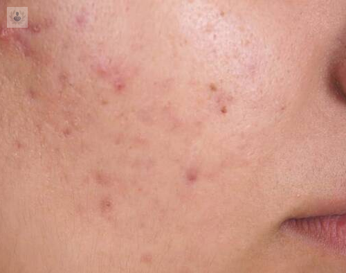 acne-afeccion-cutanea-recurrente imagen de artículo
