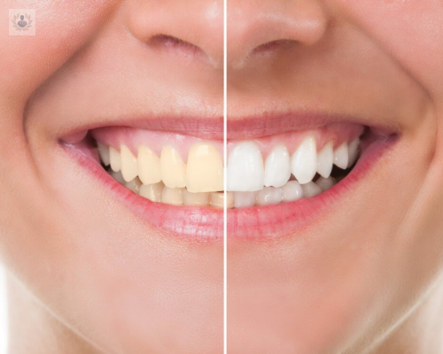 todo-lo-que-debes-saber-del-blanqueamiento-dental imagen de artículo